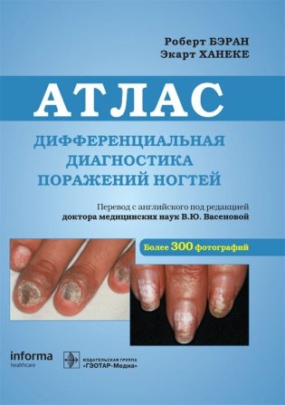 Дифференциальная диагностика поражений ногтей. Атлас фото книги