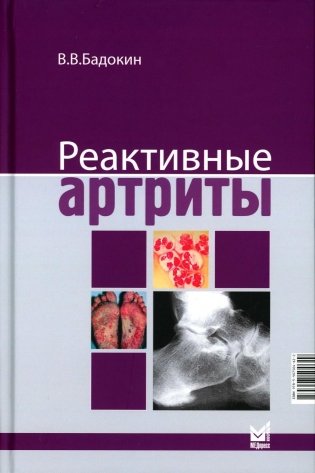 Реактивные артриты. Урогенитальные и постэнтероколитические. 2-е изд фото книги
