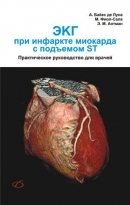 ЭКГ при инфаркте миокарда с подъемом ST фото книги