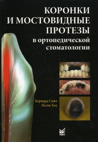 Коронки и мостовидные протезы в ортопедической стоматологии фото книги