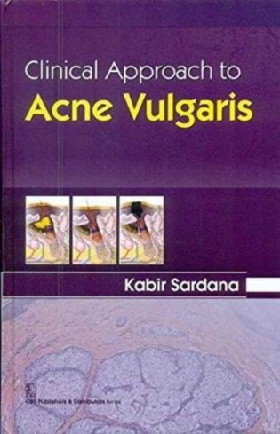 Clinical approach to acne vulgaris фото книги