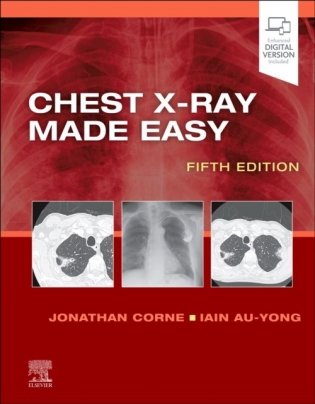 Chest x-ray made easy фото книги