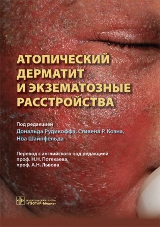 Атопический дерматит и экзематозные расстройства фото книги