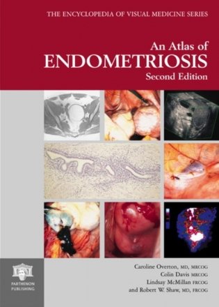 Atlas Of Endometriosis фото книги